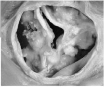 Aortenstenose 